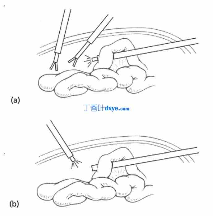 插管存在的问题及解决方法