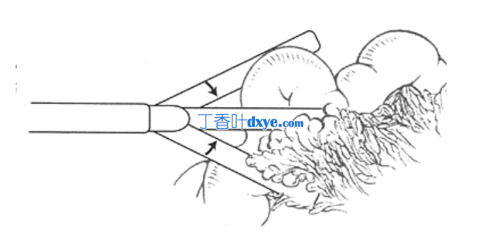 腹腔镜下收回技术