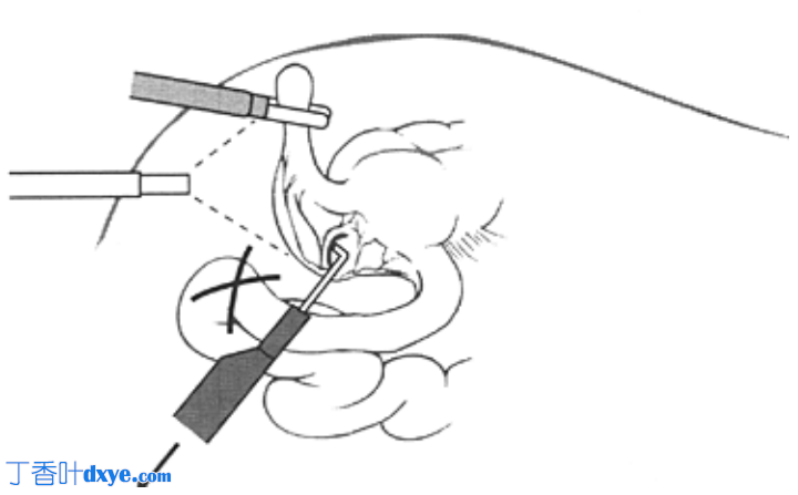 腹腔镜电凝术