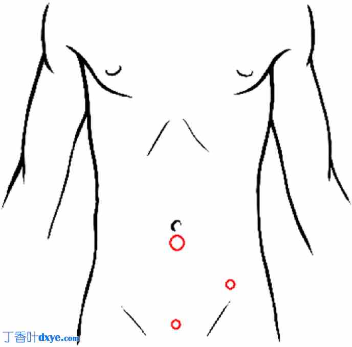 腹腔镜阑尾切除术Zaragoza技术