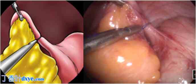 腹腔镜阑尾切除术Zaragoza技术