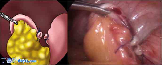 腹腔镜阑尾切除术Zaragoza技术