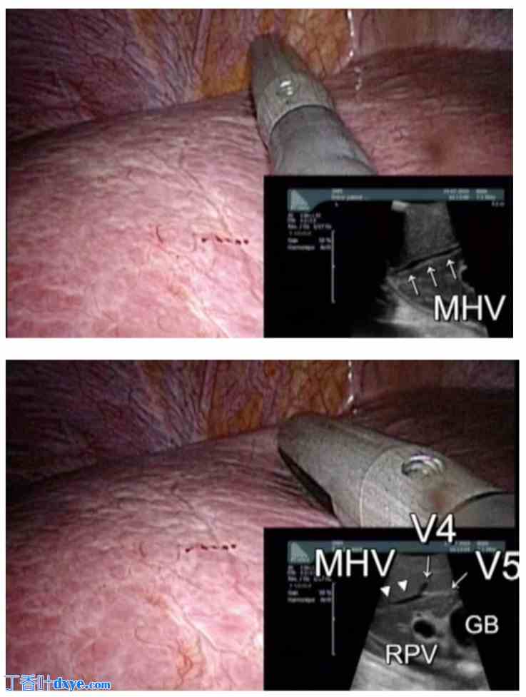 多次腹腔镜肝切除术治疗结直肠癌肝转移