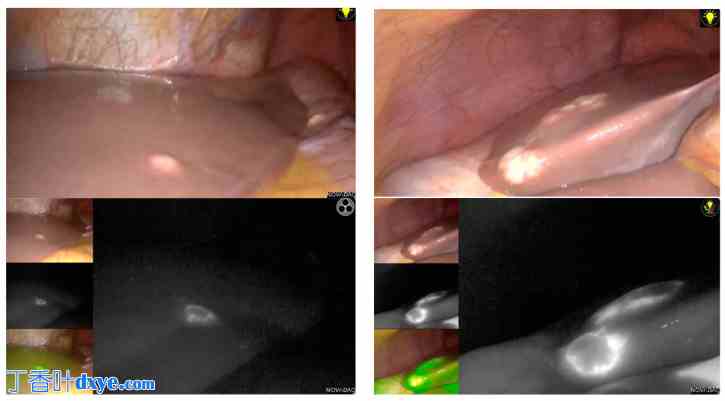 多次腹腔镜肝切除术治疗结直肠癌肝转移