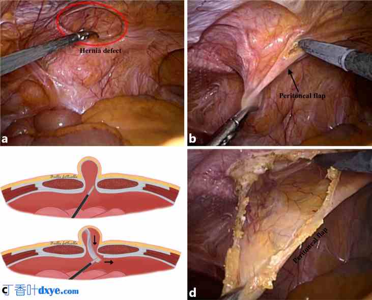使用腹膜内覆盖网片和腹膜桥接技术进行腹腔镜腹侧疝和切口疝修补术