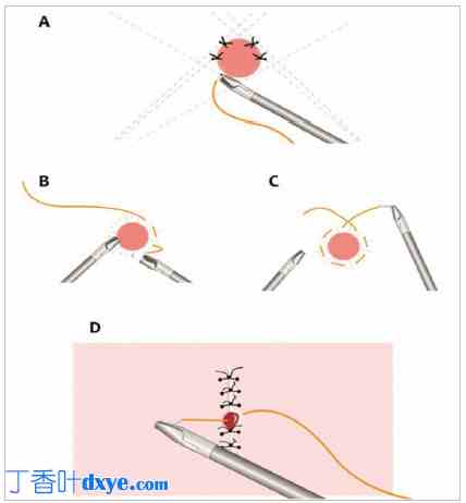 硅胶模型中腹腔镜结训练的评估