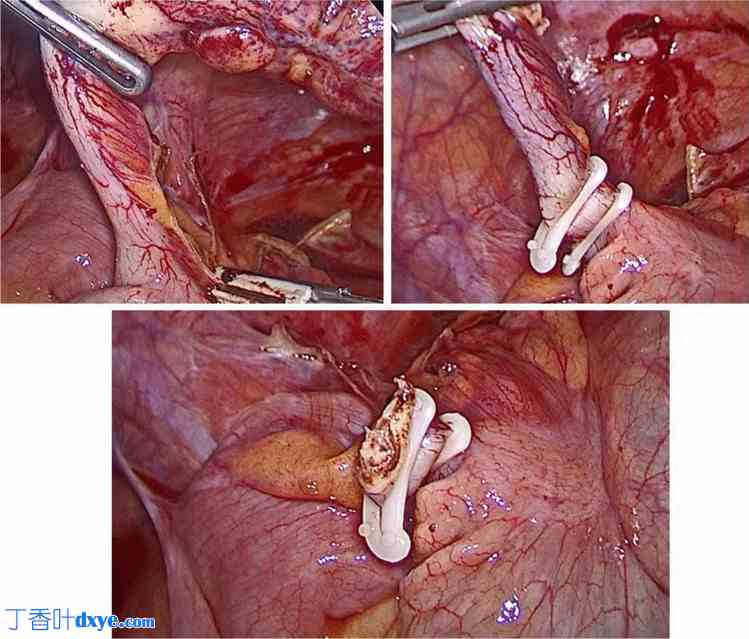 腹腔镜阑尾切除术中使用单 Hem-o-lok 夹与双 Hem-o-lok 夹固定阑尾残端的效果对比 ...