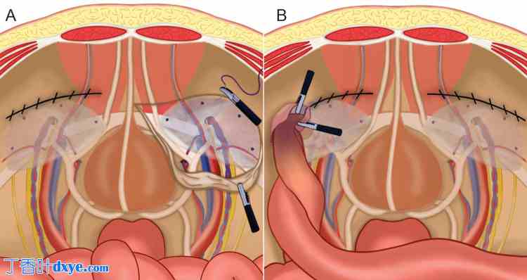 双侧腹股沟疝修补术后罕见并发症：囊袋疝病例报告