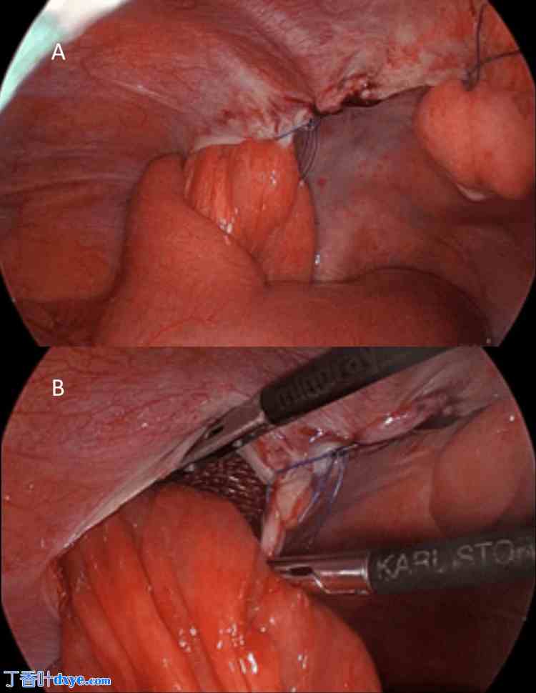 双侧腹股沟疝修补术后罕见并发症：囊袋疝病例报告