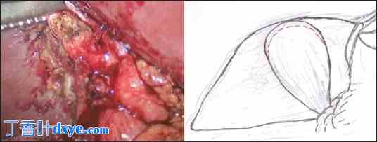 腹腔镜改良次全胆囊切除术治疗困难胆囊：单中心经验