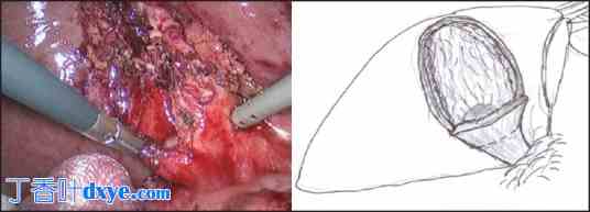 腹腔镜改良次全胆囊切除术治疗困难胆囊：单中心经验
