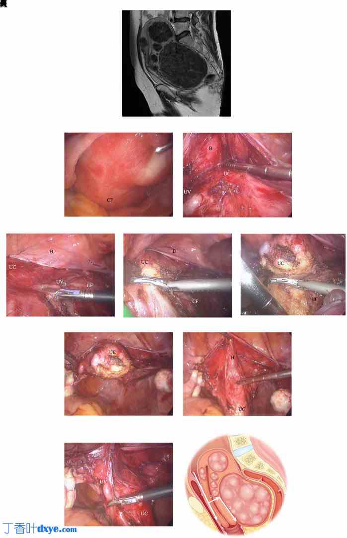 大型宫颈肌瘤全腹腔镜子宫切除术的策略和结果