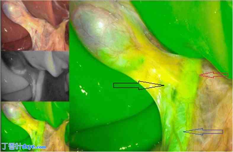 吲哚菁绿荧光透视在腹腔镜胆囊切除术中胆管可视化的作用：一项针对 70 例患者的观察性 ... ...