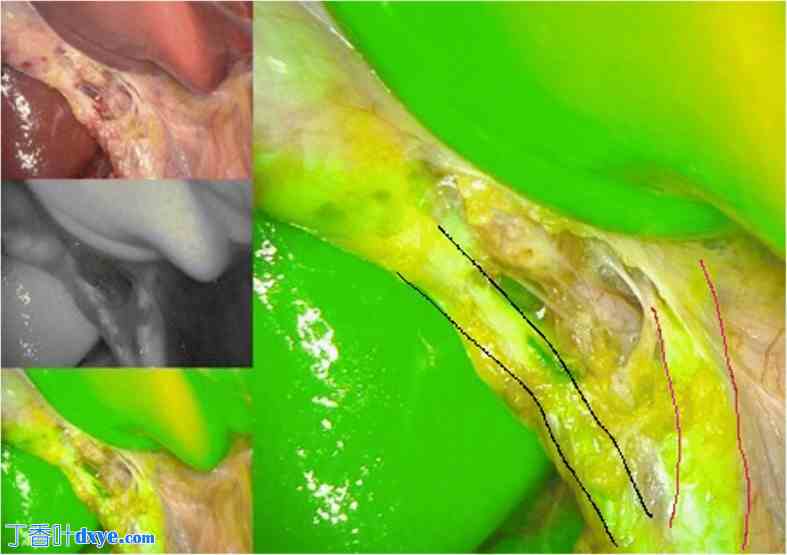 吲哚菁绿荧光透视在腹腔镜胆囊切除术中胆管可视化的作用：一项针对 70 例患者的观察性 ... ...
