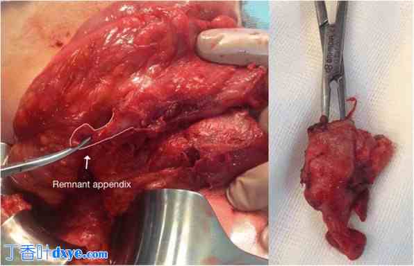 残端阑尾炎：3130 例连续阑尾切除术病例的回顾性分析