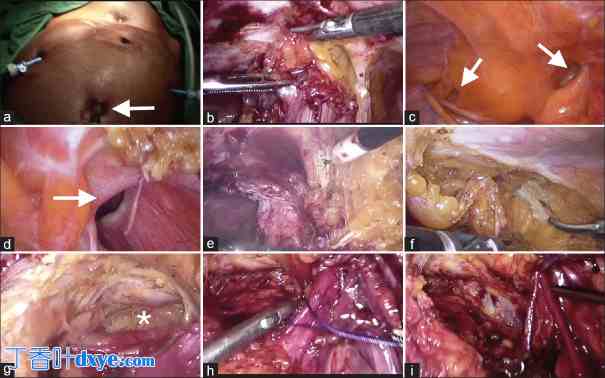 腹腔镜手术后复发性腹股沟疝再次手术的可行性和安全性