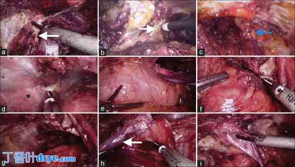 腹腔镜手术后复发性腹股沟疝再次手术的可行性和安全性