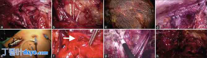 腹腔镜手术后复发性腹股沟疝再次手术的可行性和安全性