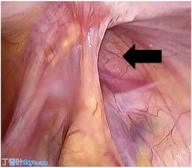 腹腔镜混合入路手术治疗复发性腹股沟疝一例