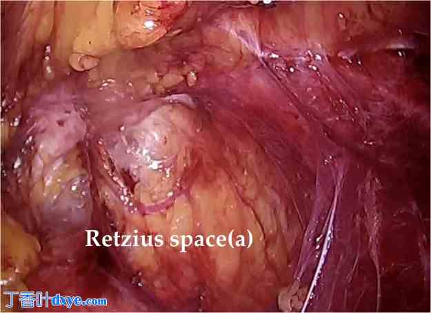 腹腔镜混合入路手术治疗复发性腹股沟疝一例