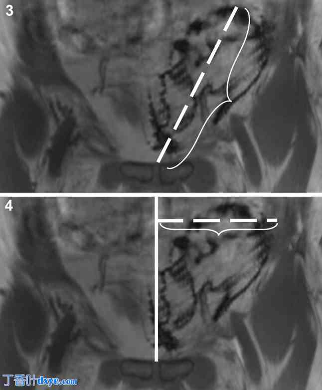 TAPP 修复后 MRI 可显示的网状植入物的手术和放射学行为：IRONMAN 研究