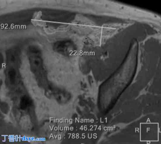 TAPP 修复后 MRI 可显示的网状植入物的手术和放射学行为：IRONMAN 研究