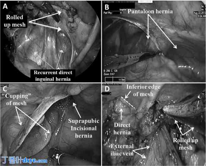 单切口腹腔镜腹膜内补片修补治疗多发性复发性腹股沟疝
