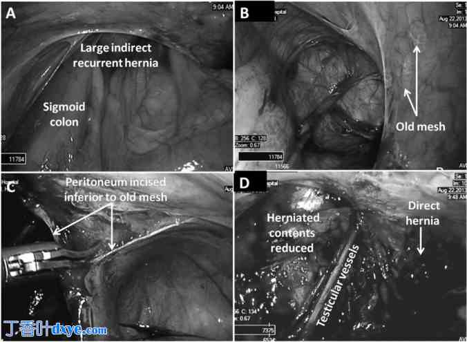 单切口腹腔镜腹膜内补片修补治疗多发性复发性腹股沟疝