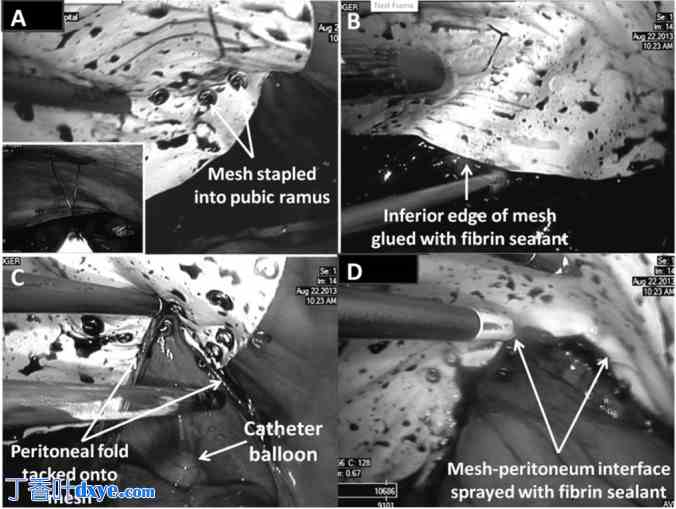 单切口腹腔镜腹膜内补片修补治疗多发性复发性腹股沟疝