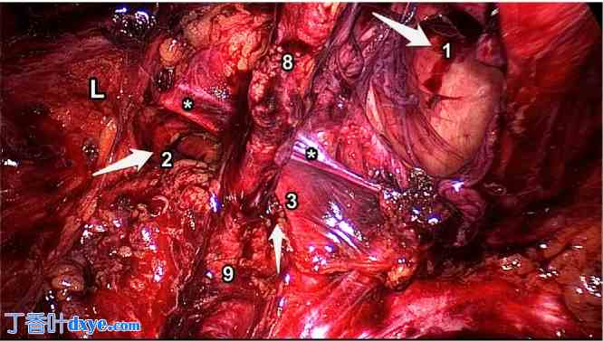 同一患者同时出现多发性双侧腹股沟疝；病例报告及罕见腹股沟疝回顾：成功修复后持续疼 ... ...