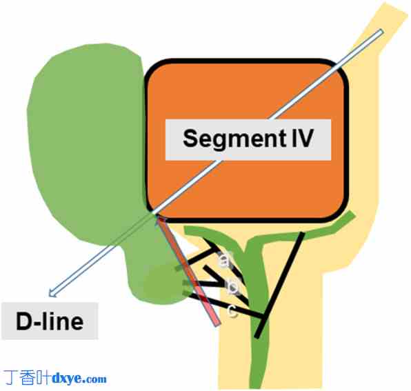 第四段入路：在胆管异常患者中实施腹腔镜胆囊切除术时实现安全性的关键方法 ... ...