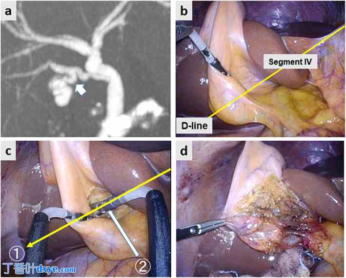 第四段入路：在胆管异常患者中实施腹腔镜胆囊切除术时实现安全性的关键方法 ... ...