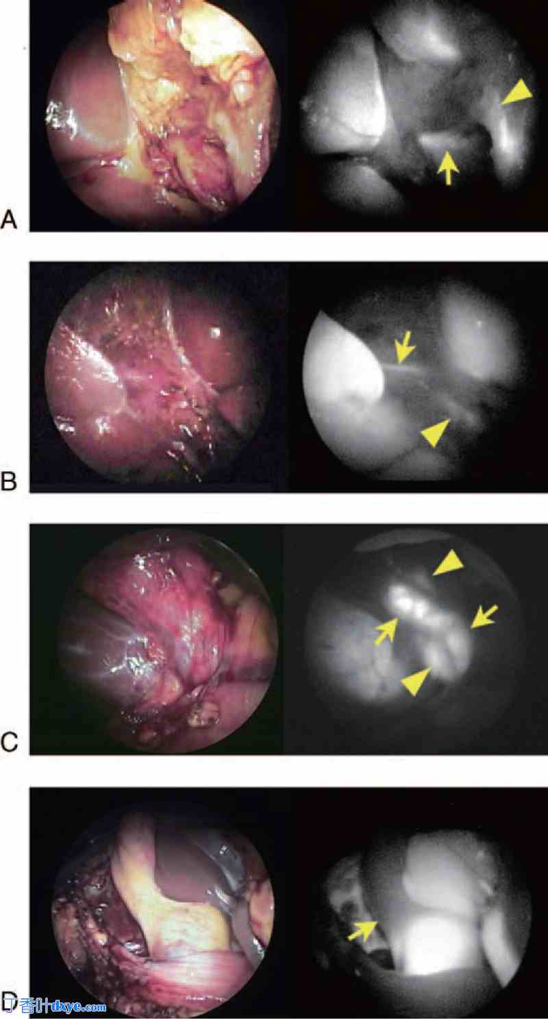 腹腔镜胆囊切除术中荧光胆管造影技术对胆管解剖结构的更好描绘