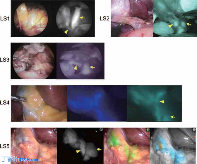 腹腔镜胆囊切除术中荧光胆管造影技术对胆管解剖结构的更好描绘