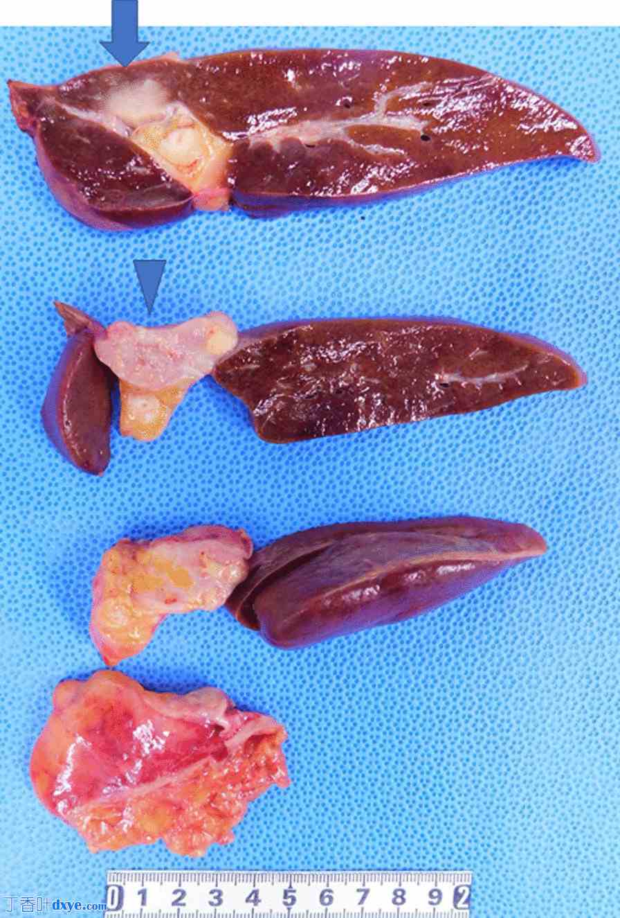 腹腔镜左肝切除术治疗镰状韧带肝内胆管癌转移一例