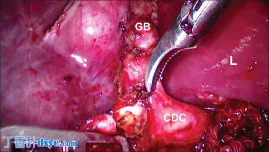 改良腹腔镜胆总管囊肿切除术：技术与早期结果