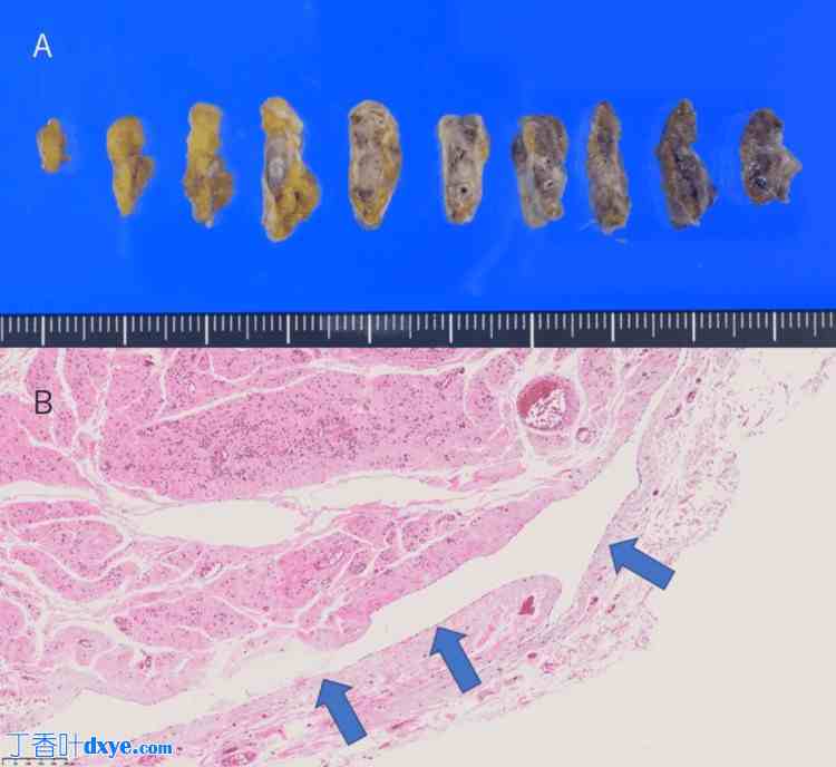 经腹腹膜前修补术治疗卵巢嵌顿性膀胱上外疝：一例病例报告