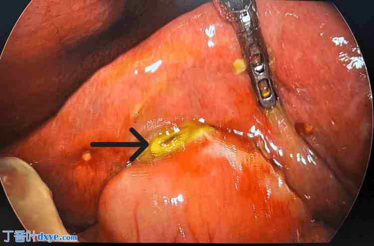 腹腔镜治疗无结石性胆囊炎自发性胆囊穿孔：病例系列