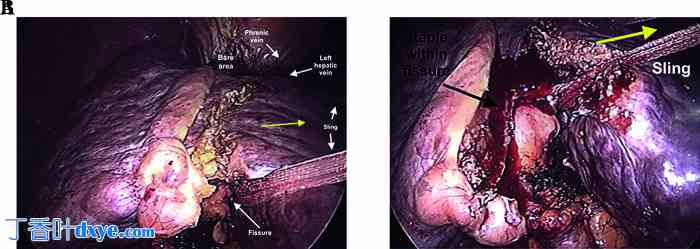 腹腔镜肝操作吊带技术