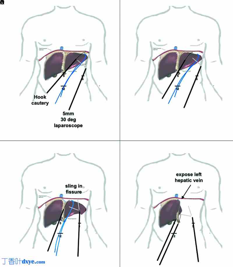 腹腔镜肝操作吊带技术