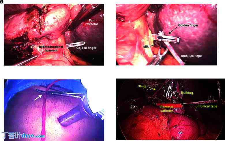 腹腔镜肝操作吊带技术