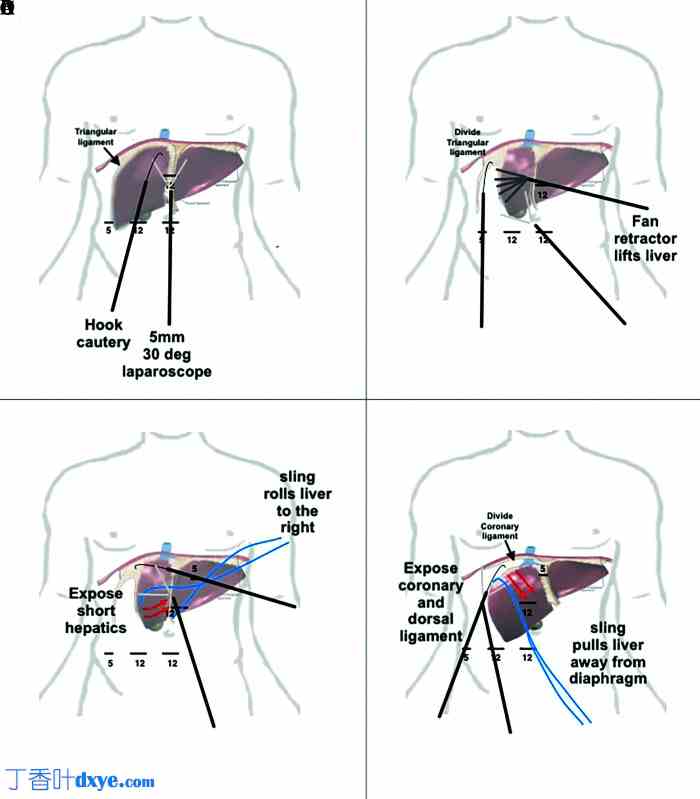 腹腔镜肝操作吊带技术