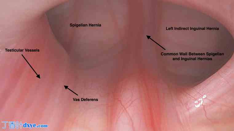 睾丸疝和隐睾综合征：开放式睾丸疝修补术和腹腔镜一期睾丸固定术治疗异位睾丸 ... ...