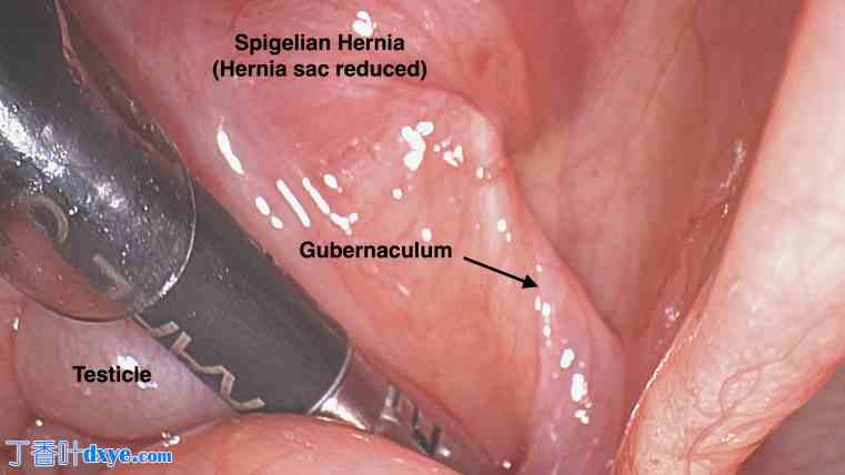 睾丸疝和隐睾综合征：开放式睾丸疝修补术和腹腔镜一期睾丸固定术治疗异位睾丸 ... ...