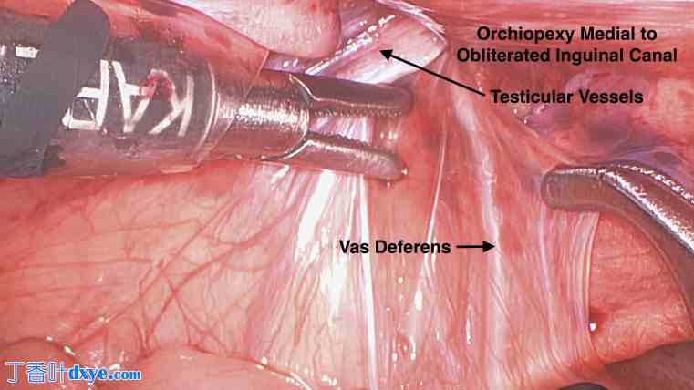 睾丸疝和隐睾综合征：开放式睾丸疝修补术和腹腔镜一期睾丸固定术治疗异位睾丸 ... ...