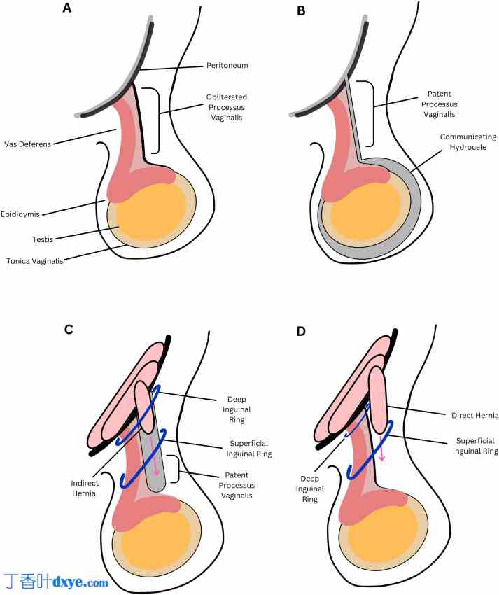 睾丸疝和隐睾综合征：开放式睾丸疝修补术和腹腔镜一期睾丸固定术治疗异位睾丸 ... ...