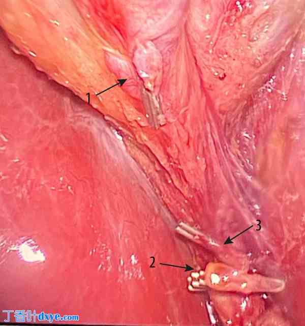 64 岁男性腹腔镜胆囊切除术后乳糜漏诊治报告